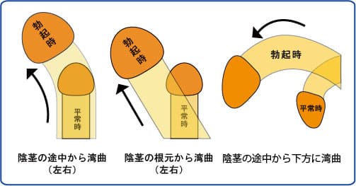 ペニスの曲がりをまっすぐにする治療